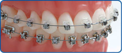 damon-fixed-braces
